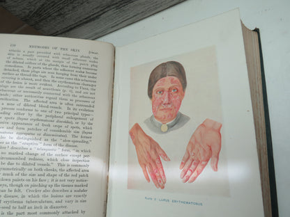 Diseases of the Skin An Outline of the Principles and Practice of Dermatology By Sir Malcolm Morris 1917