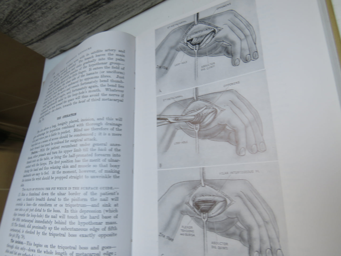 Extensile Exposure By Arnold K. Henry 1973